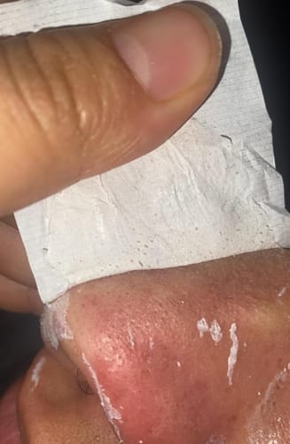 Customer photo review of LANBÉNA Blackhead Remover Mask