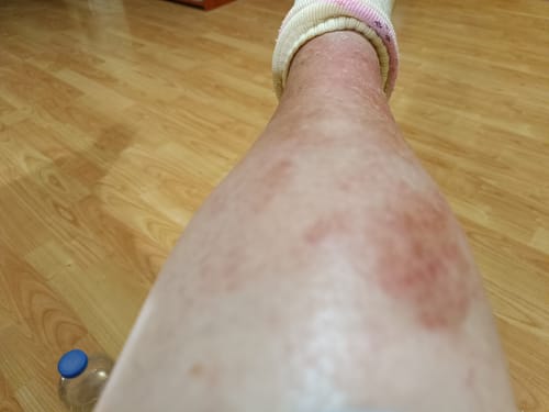 Customer photo review of Sereni Pikkelysömör és Ekcéma Krém