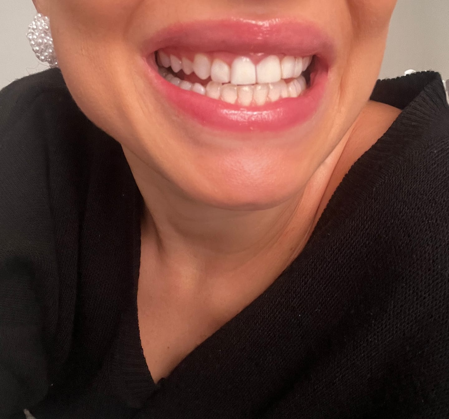 Customer photo review of Zahnbleaching-Set Rapid+ Dental Beauty - Teeth Whitening Kit