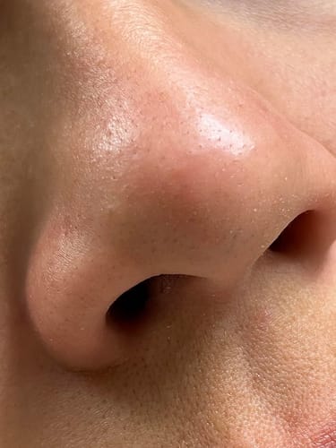 Customer photo review of LANBÉNA Blackhead Remover Mask
