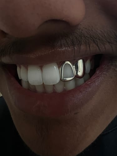 Customer photo review of PRISM (GOLD GRILLZ)