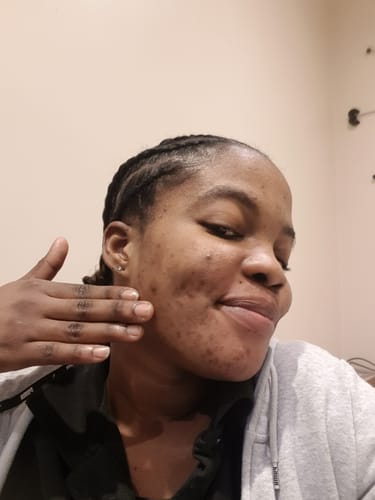 Customer photo review of Anti-Acne & Dark Spots African Soap