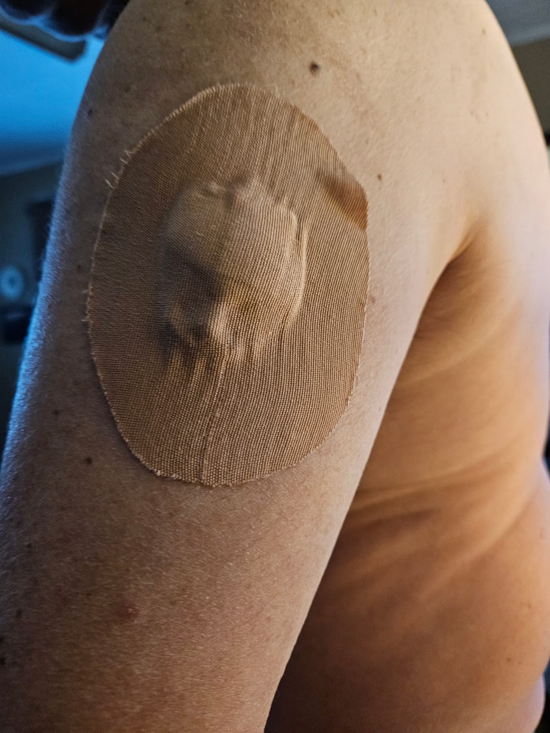 Customer photo review of Skin Grip Original - Medtronic Guardian/Enlite Adhesive Patches