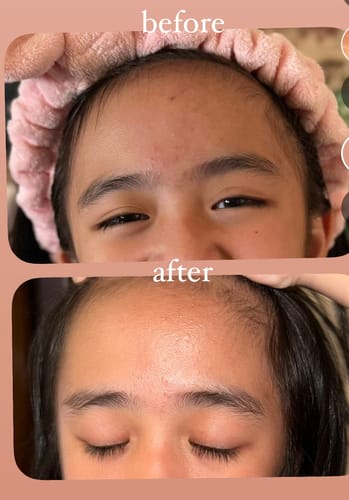 Customer photo review of Mini Acne Clearing Kit