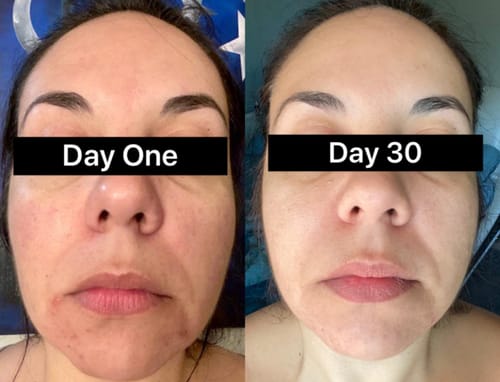 Customer photo review of NextGen Red Light Mask