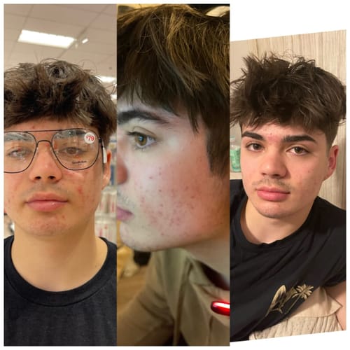 Customer photo review of NextGen Red Light Mask