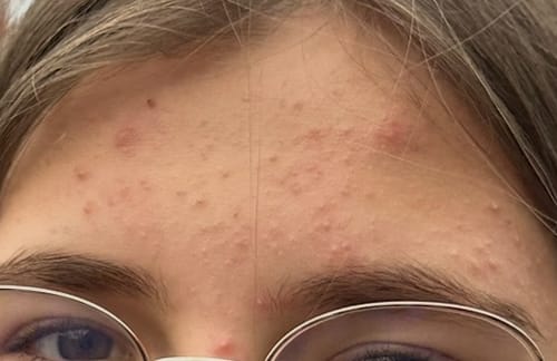 Kristina V. review of SOME BY MI AHA.BHA.PHA 30 Days Miracle Acne Clear Foam veido prausiklis image 1 out of 2