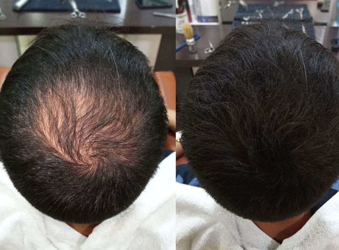 Customer photo review of Fibre copri Calvizie da 27.5gr  | Castano Scuro | 60 Giorni di applicazioni