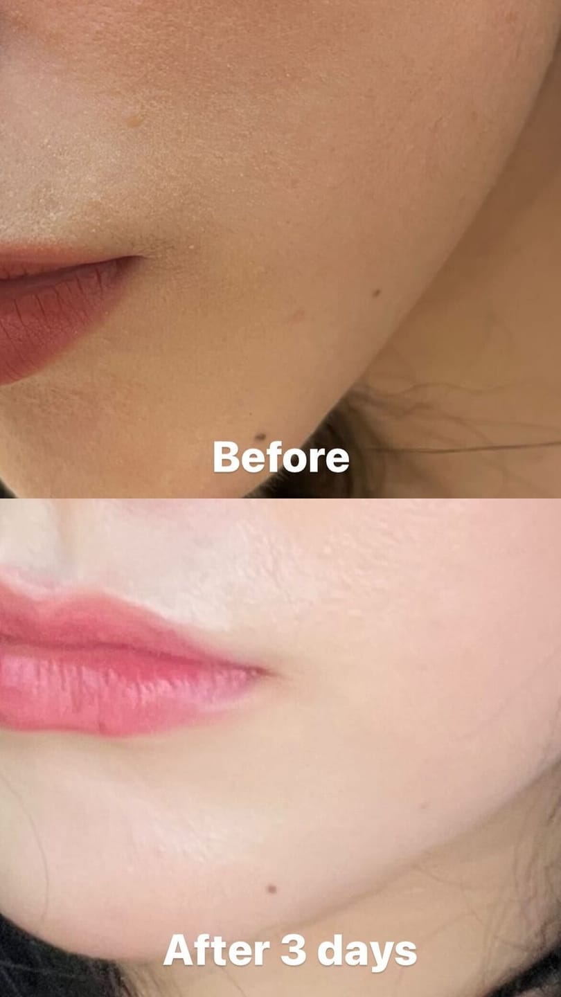 Customer photo review of Glutathiosome dark spot serum Vita drop