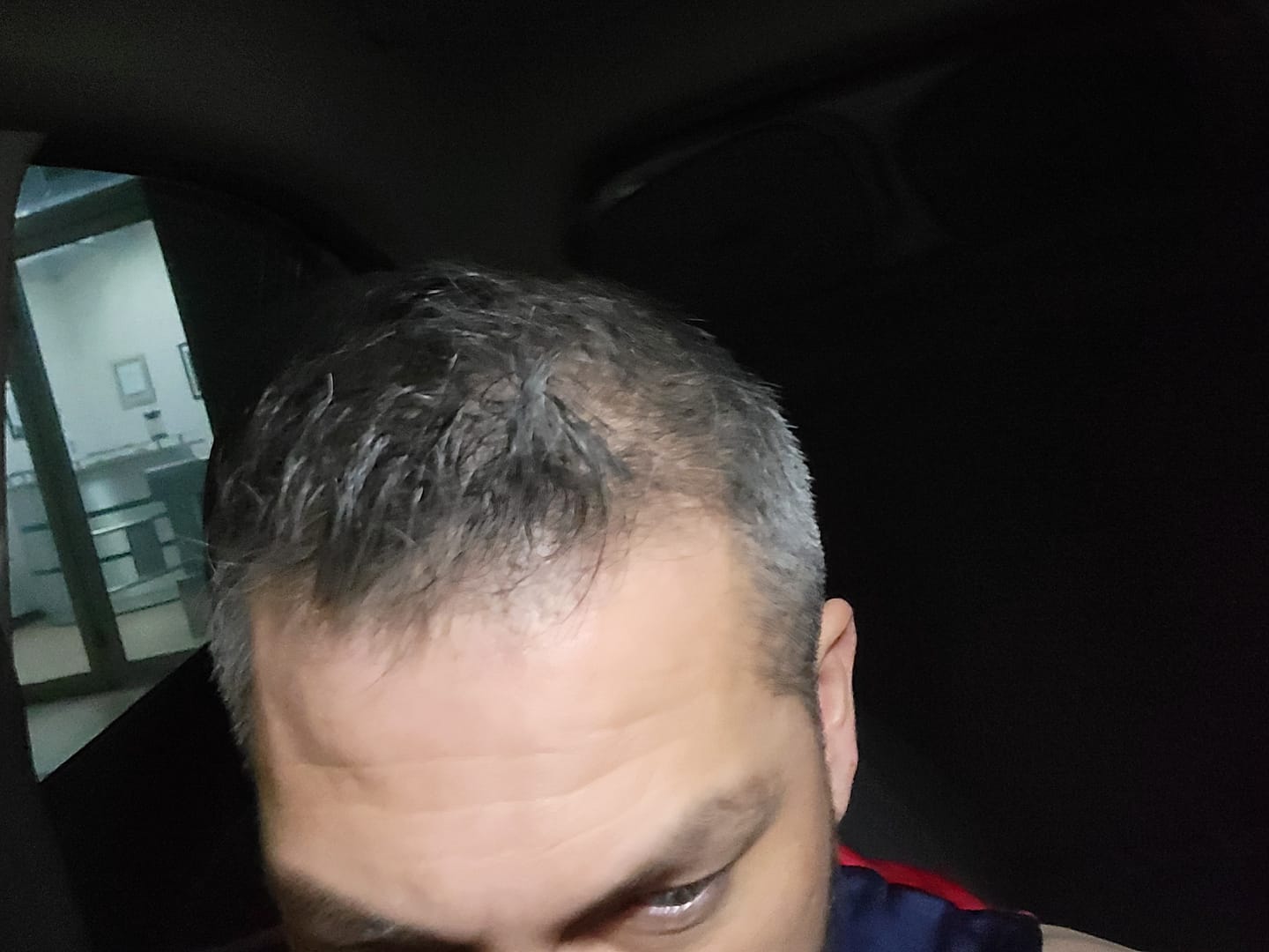 Customer photo review of Kit Adiós Alopecia