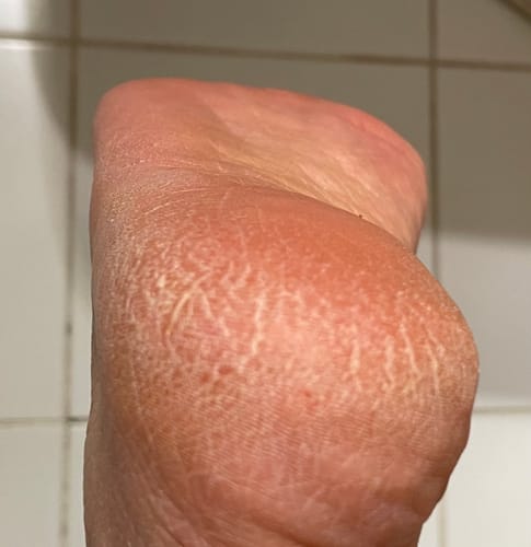 Customer photo review of LOVASKIN INSTANT FOOT PEEL Deluxe Kit - Less than 3.20 per treatment