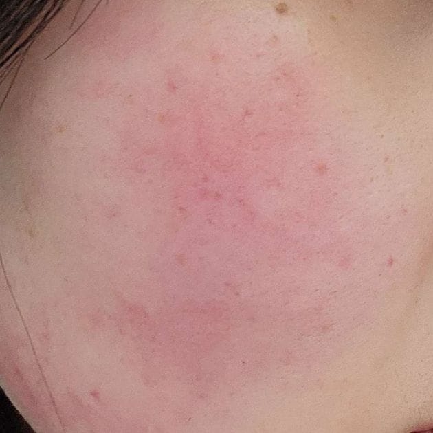 Customer photo review of Glutathiosome dark spot serum Vita drop
