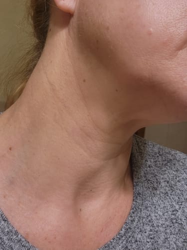 Customer photo review of Glov Micro Infusion System