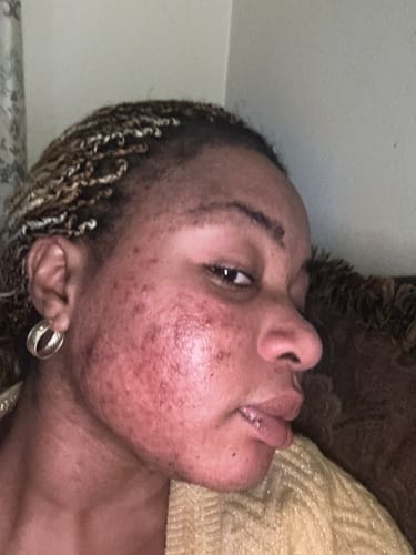 Customer photo review of Fair and White Original Dark Spot Remover 30 ml / 1 fl oz