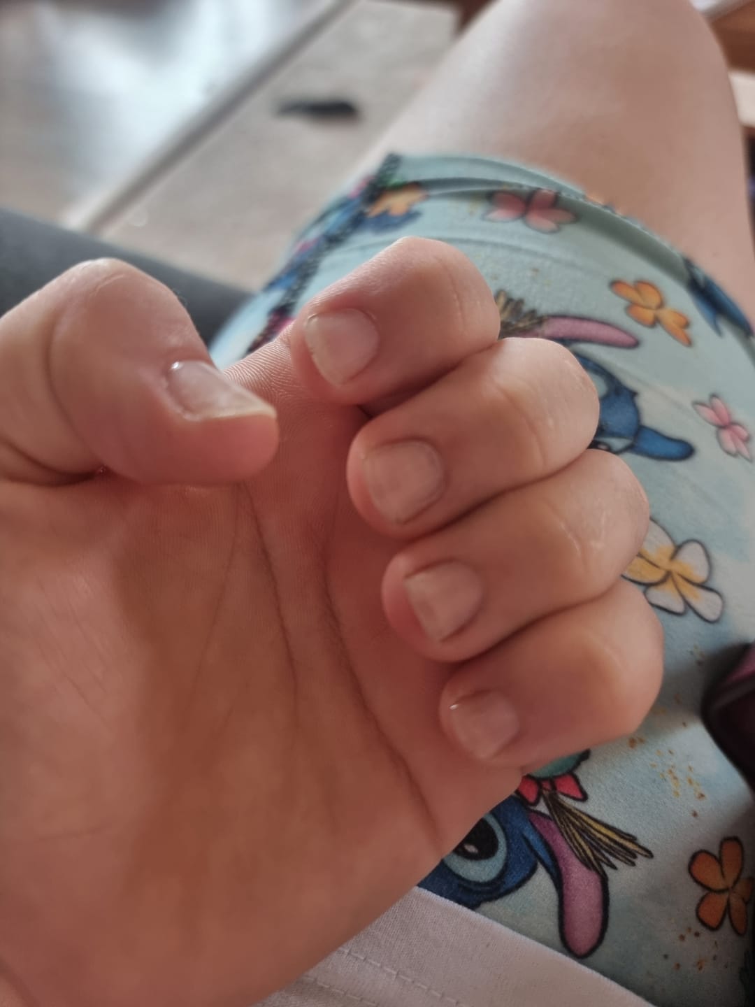 Customer photo review of Crystal Clear DIY Semicured Gel Nail Sticker Kit (STOP NAIL BITING & GROW BRITTLE NAILS)