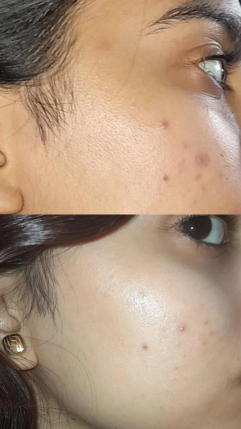 Customer photo review of CLEAN SWEEP - 2% BHA Pore-Minimizing Toner (w/ purifying Charcoal)
