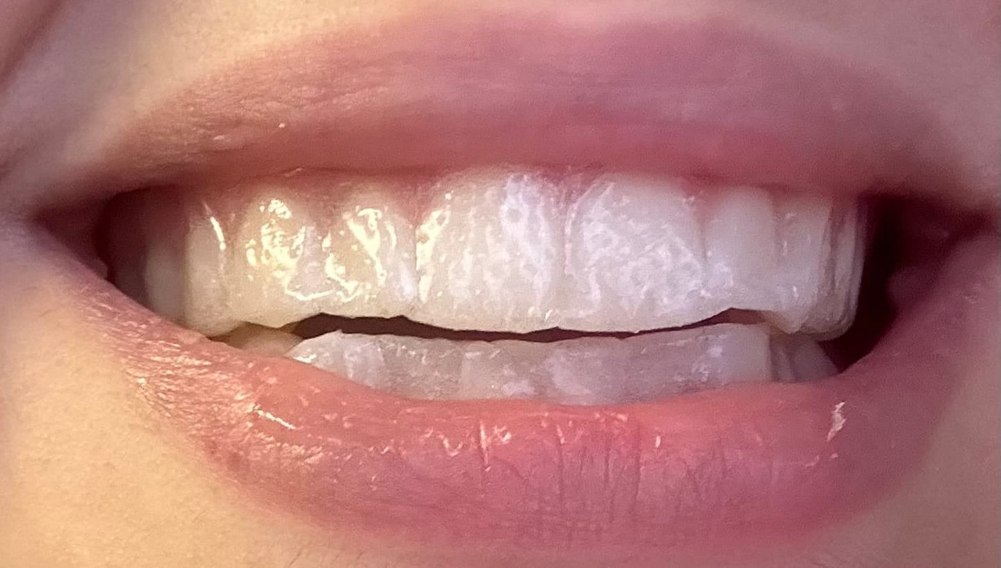 Customer photo review of Teeth Whitening Strips