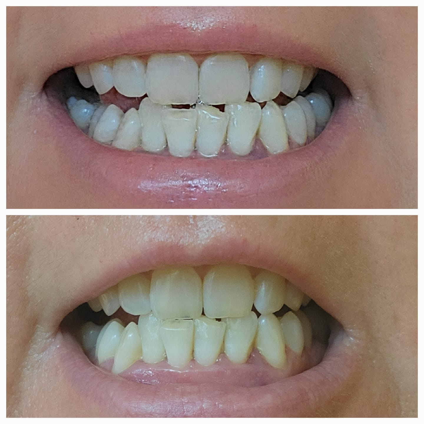 Customer photo review of TEETH WHITENING KIT