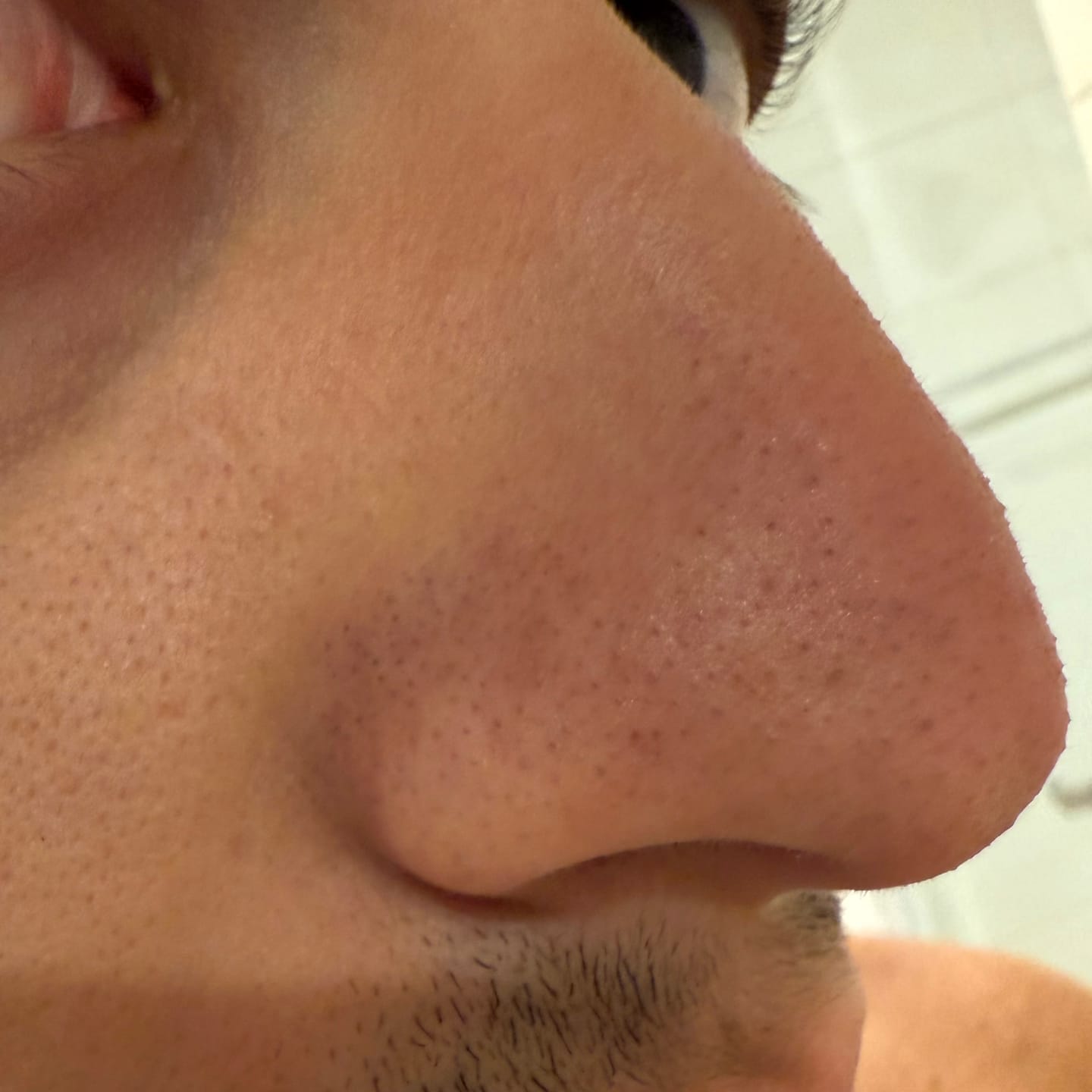 Customer photo review of OroSkin Pore-fection Blackhead Remover