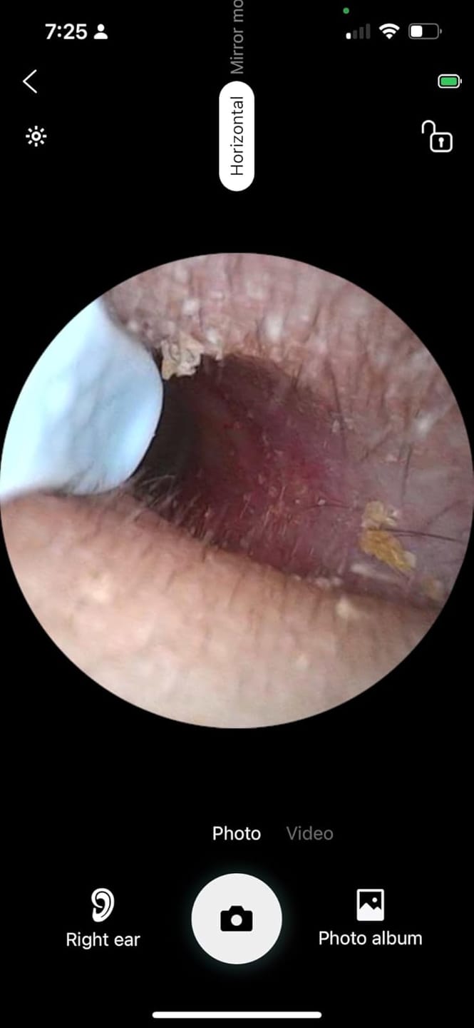 Customer photo review of Slivor VisioEar: Doctor Approved Ear Health Technology