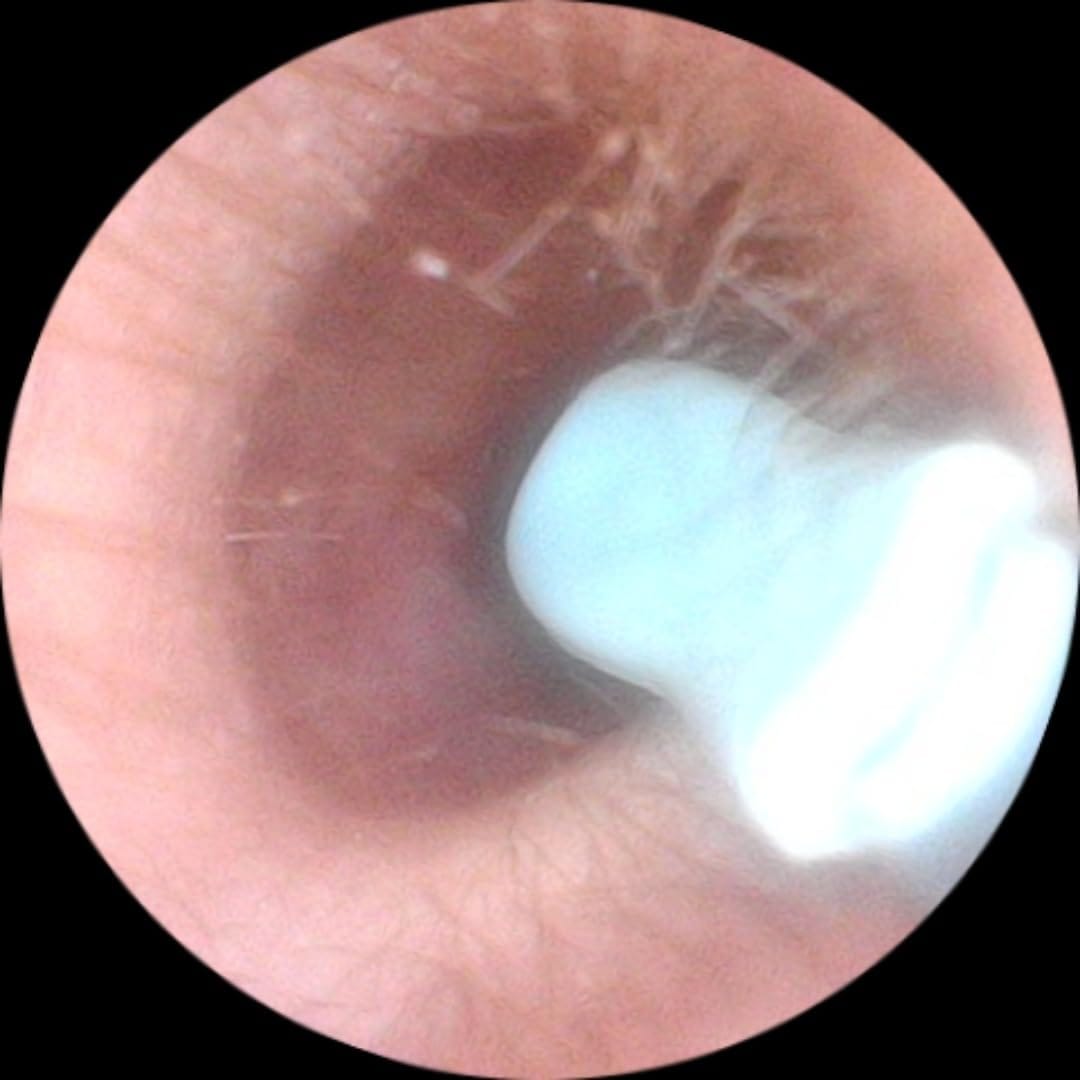 Customer photo review of Slivor VisioEar: Doctor Approved Ear Health Technology