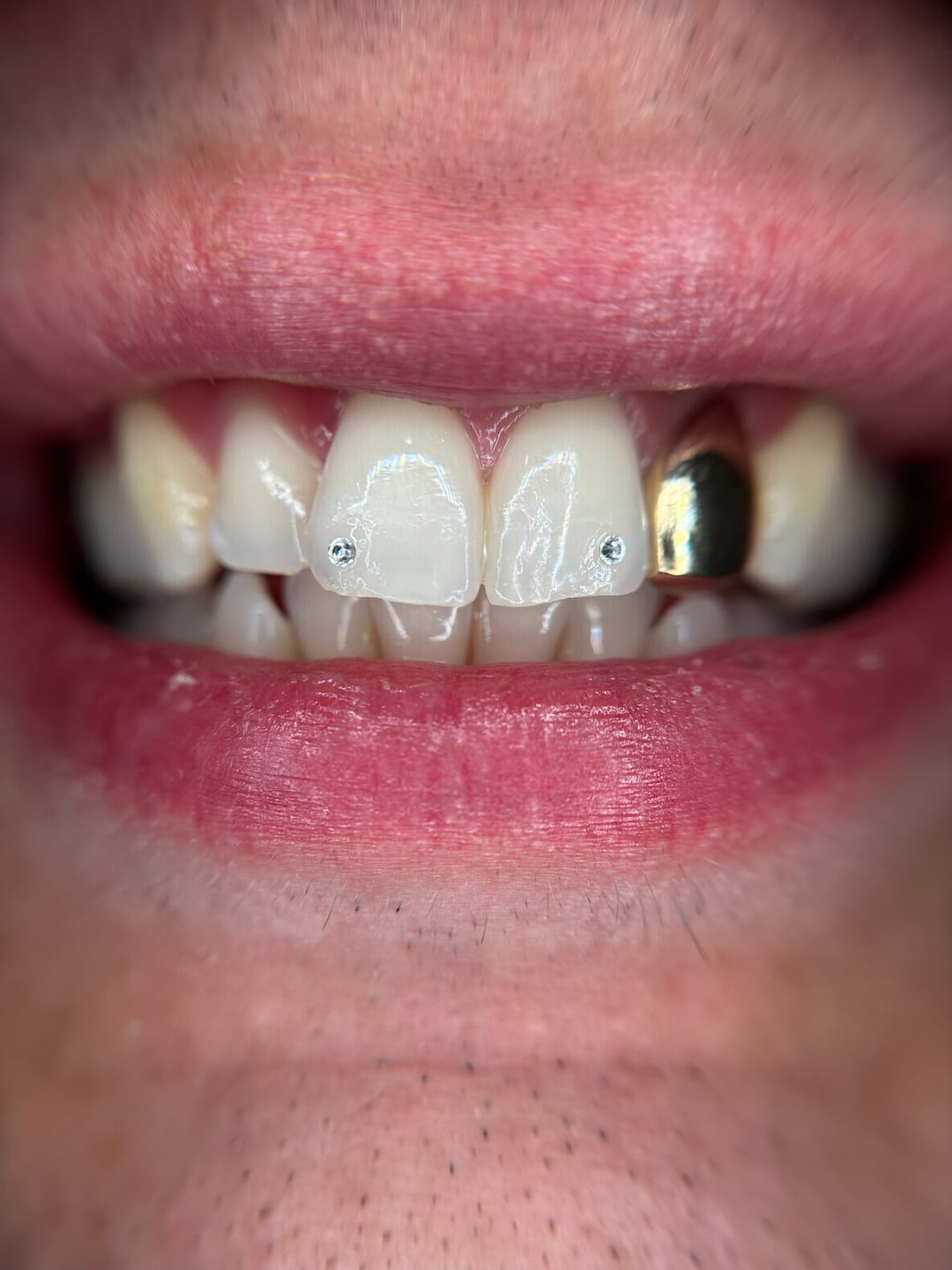 Customer photo review of Gemas Dentales Preciosa - Crystal