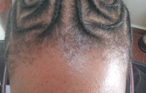 Customer photo review of Hairline Fortifying Serum 30ml - Minoxidil