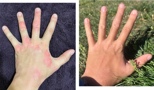 Customer photo review of Eczema Scratch Mitten