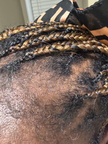 Customer photo review of Rennora EXTRA-Strength Hair Growth Serum