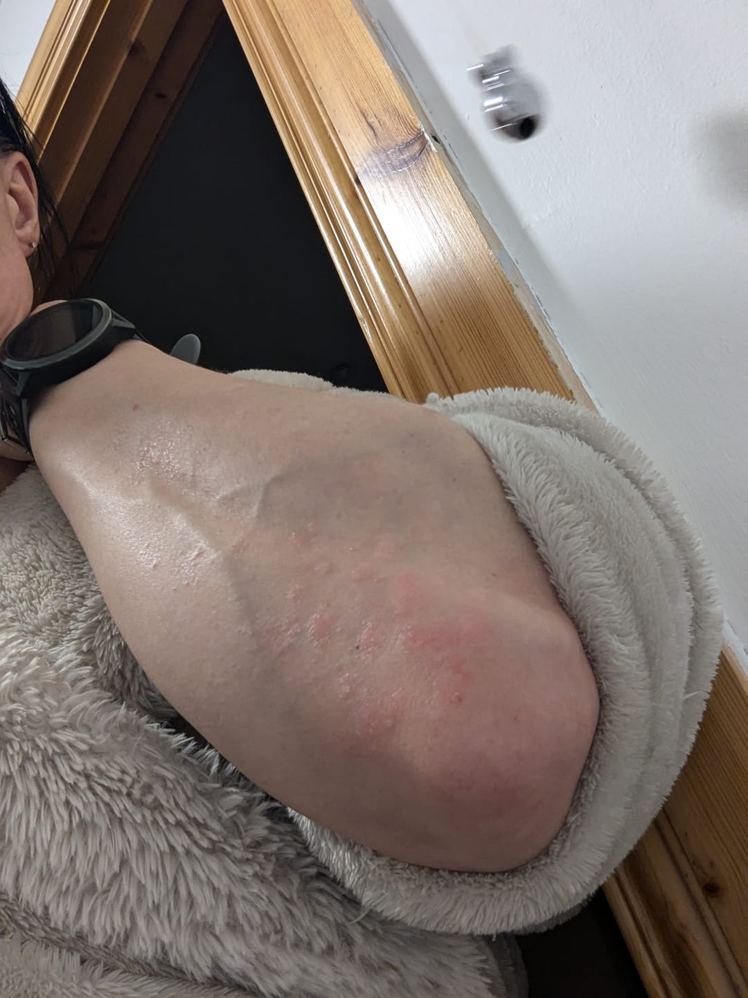 Customer photo review of Bioskin DermaSpray Intensive