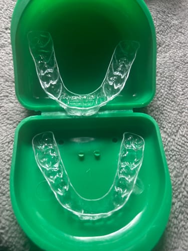 Customer photo review of Upper and Lower Retainers Set