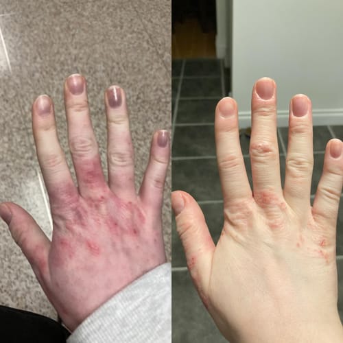 Customer photo review of Eczema Scratch Mitten