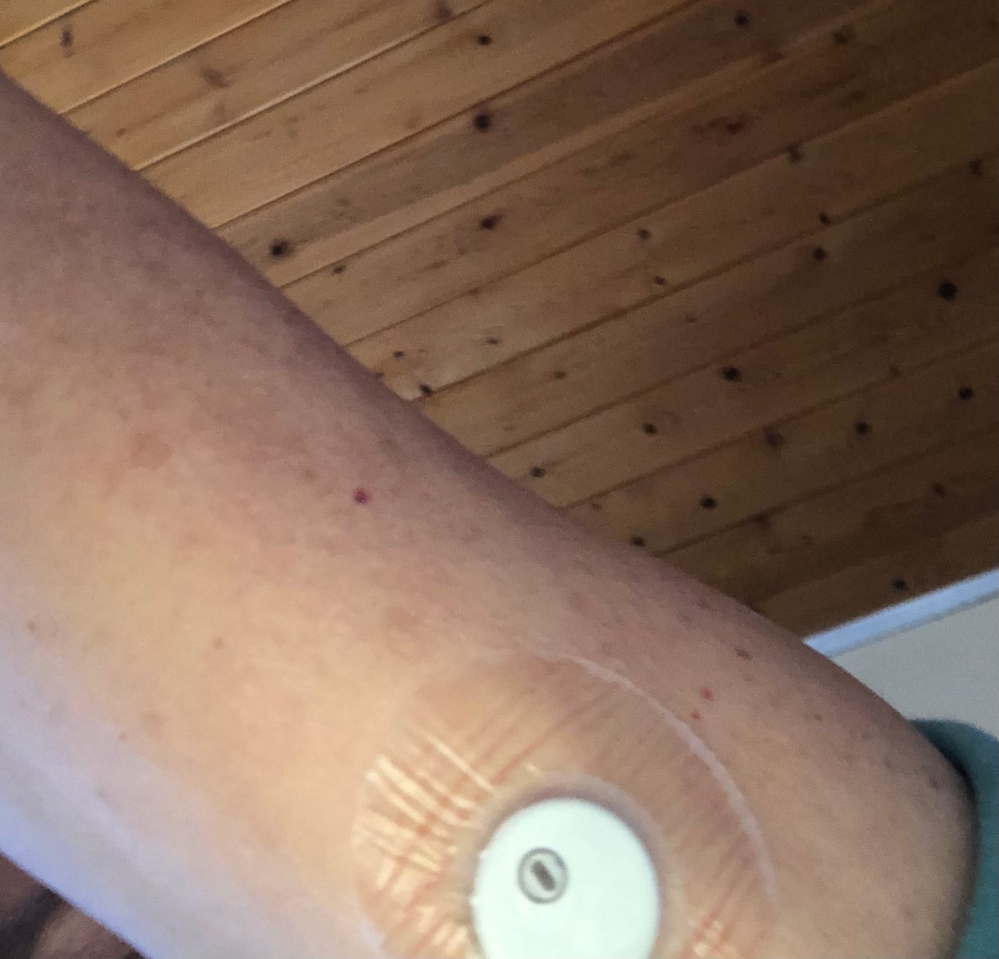 Customer photo review of Skin Grip Original - Libre 3 Adhesive Patches