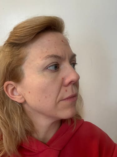 Customer photo review of The Complete Acne System for Women