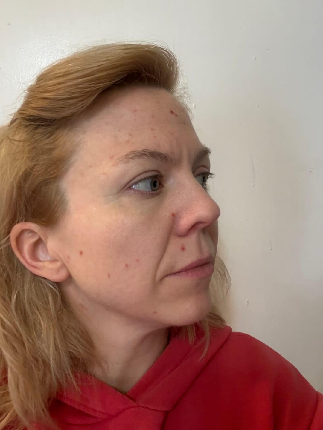 Customer photo review of The Complete Acne System for Women