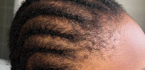 Customer photo review of Hairline Fortifying Serum 30ml - Minoxidil