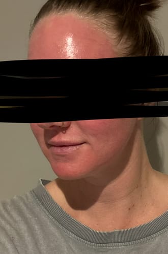 Customer photo review of *NEW* Dr. Pen A11 Ultima PRO Microneedling Pen