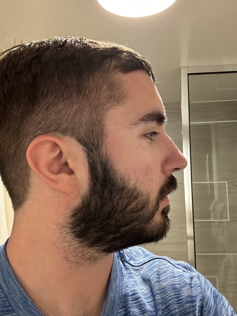 Customer photo review of Bálsamo para Crecimiento de Barba Ultra Potente con Minoxidil 20% | 100mL