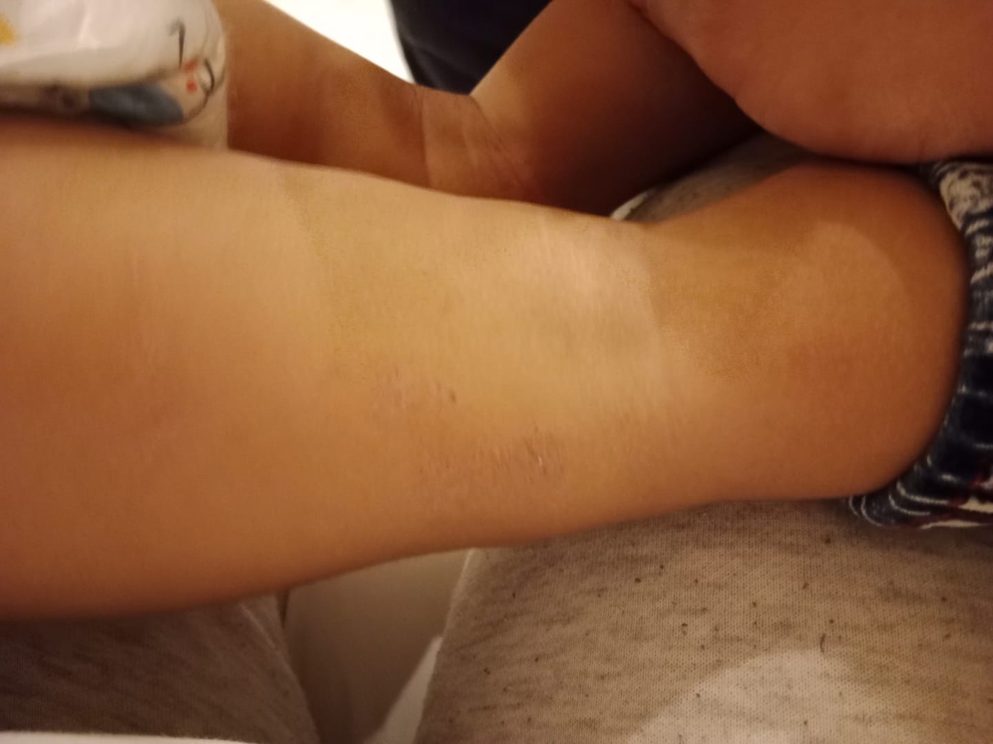 Customer photo review of Bioskin Junior Outbreak Rescue Cream
