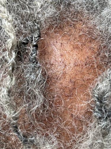 Customer photo review of Scalp Stimulator | Hair Growth Oil