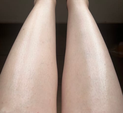 Customer photo review of Ingrown SOS