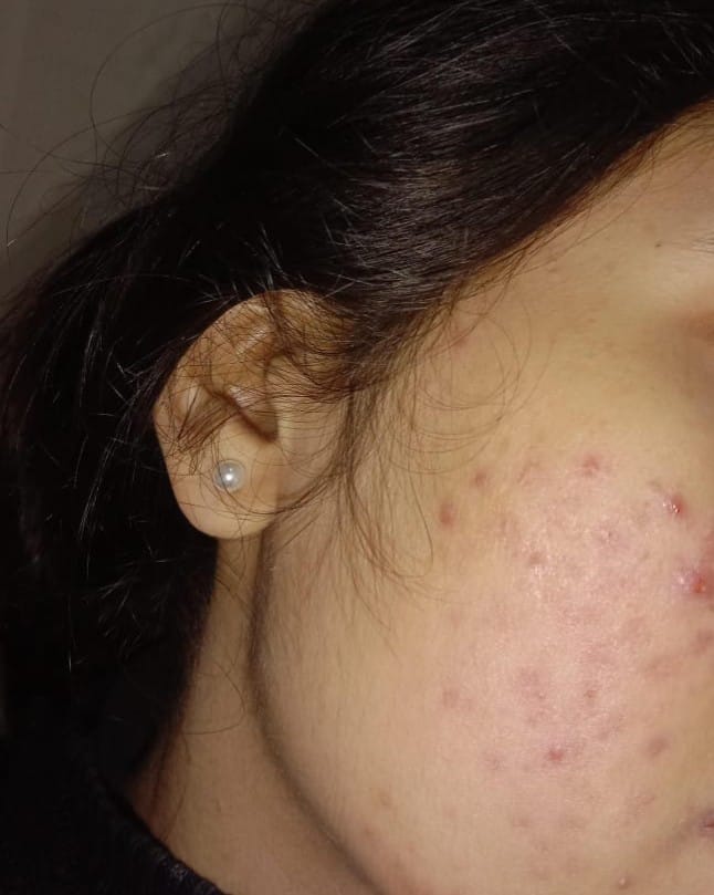 Customer photo review of CLEAN SWEEP - 2% BHA Pore-Minimizing Toner (w/ purifying Charcoal)