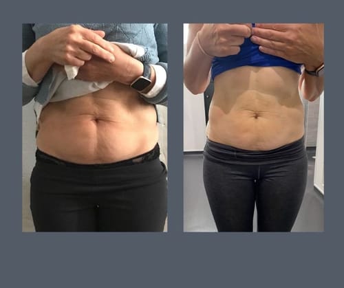Customer photo review of LumaLean Pro - For Menopause Belly