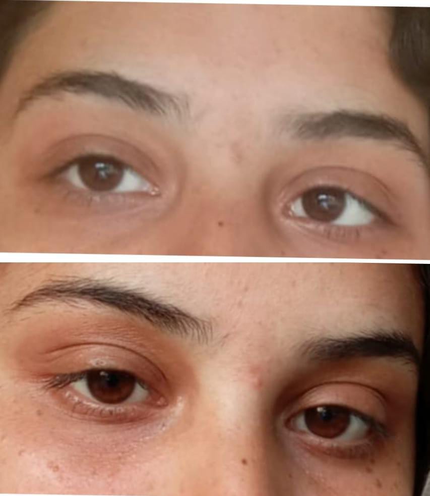 Customer photo review of Eye Roller | Eliminates Dark Circles & Puffy Eyes