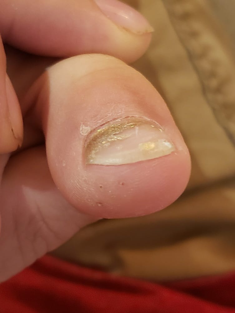 Customer photo review of The Wartabater | Electronic Wart Remover | Safe, Easy, & Effective