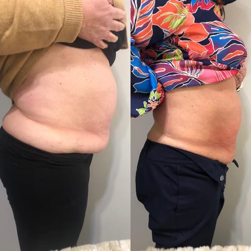Customer photo review of LumaLean Pro - For Menopause Belly