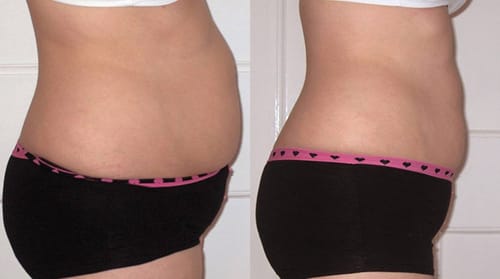 Customer photo review of LumaLean Pro - For Menopause Belly