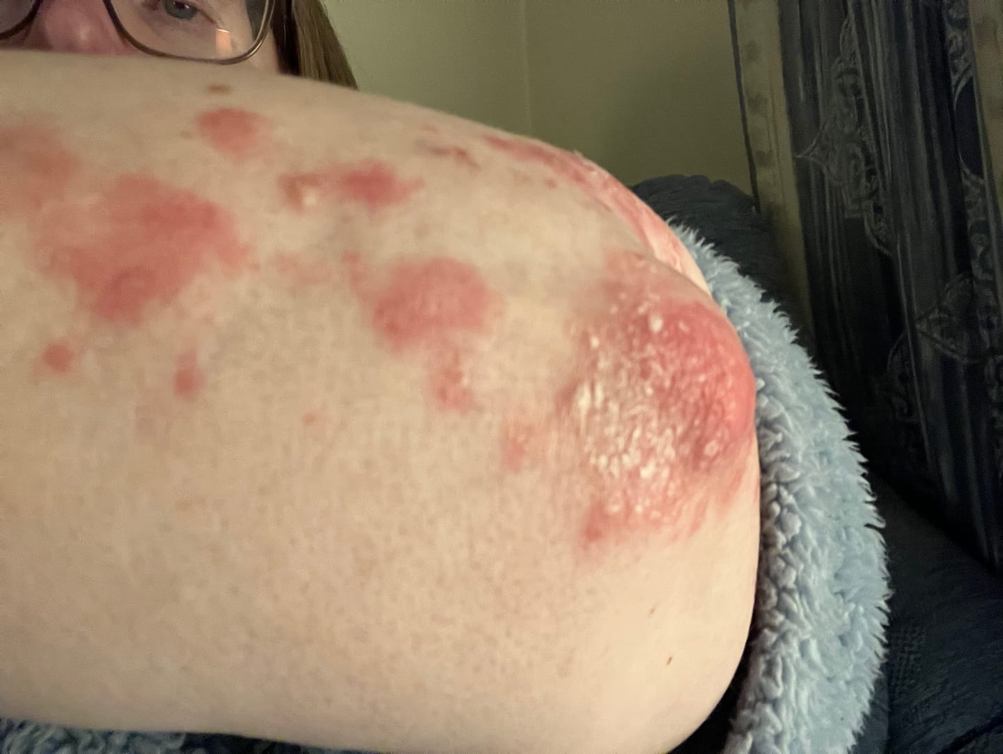Customer photo review of Bioskin Junior Outbreak Rescue Cream