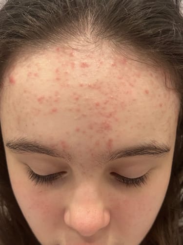 Customer photo review of Advanced Acne Program™