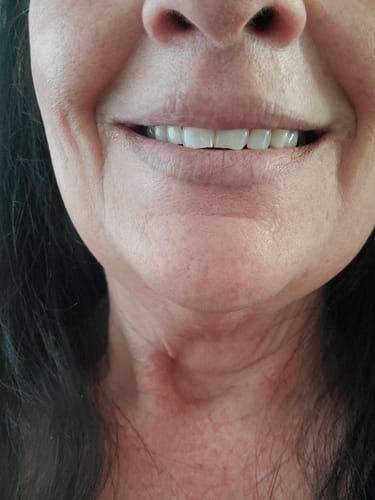 Customer photo review of Tri Pulse™ Refill Kit